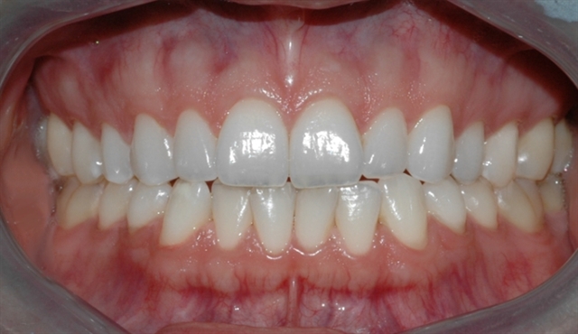 bleking_pasient_1_etter