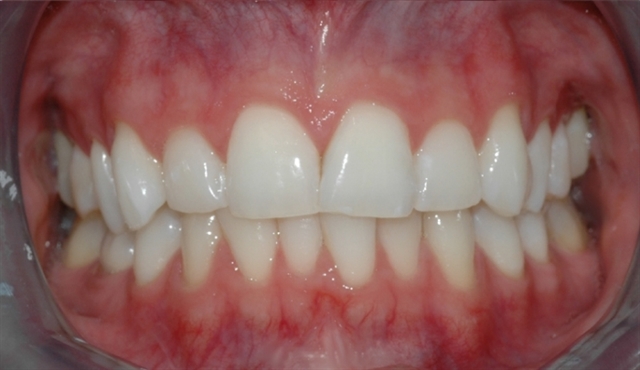 bleking_pasient_2_etter