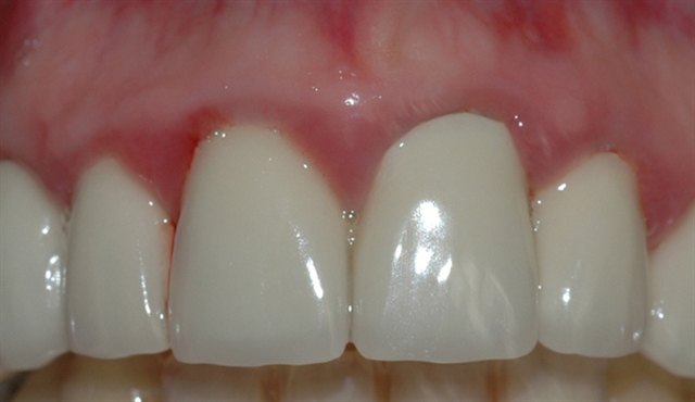 gingivitt pasient 2 1