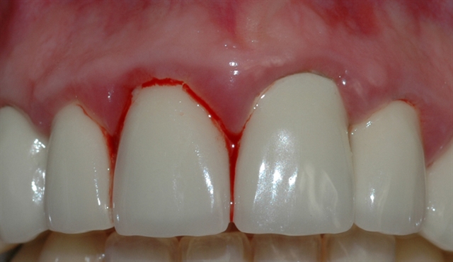 gingivitt pasient 2 2